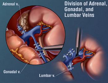 Division of adrenal, gonadal, & lumbar veins