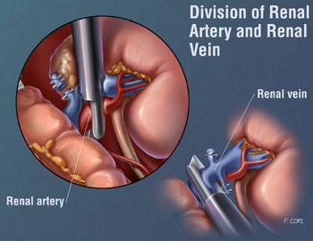 Division of renal artery and renal vein