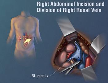 Right abdominal incision and division of rt. renal vein
