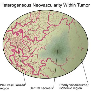 Heterogeneous vascularity