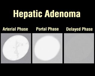 Hepatic adenoma