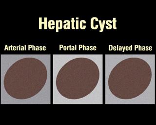 Hepatic cyst