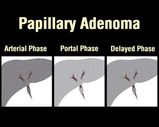Papillary adenoma