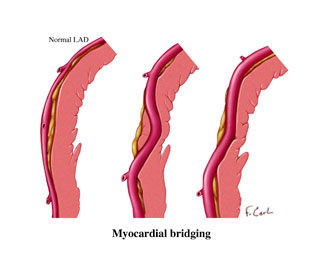 Myocardial Bridging