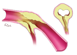 Plaque in Coronary Artery