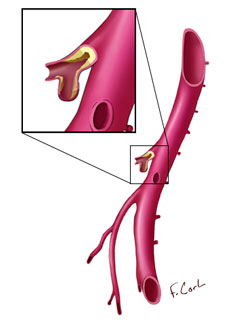 Stenosis of the Celiac Trunk Aneurysm