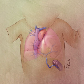 Pulmonary Venous Connection 
