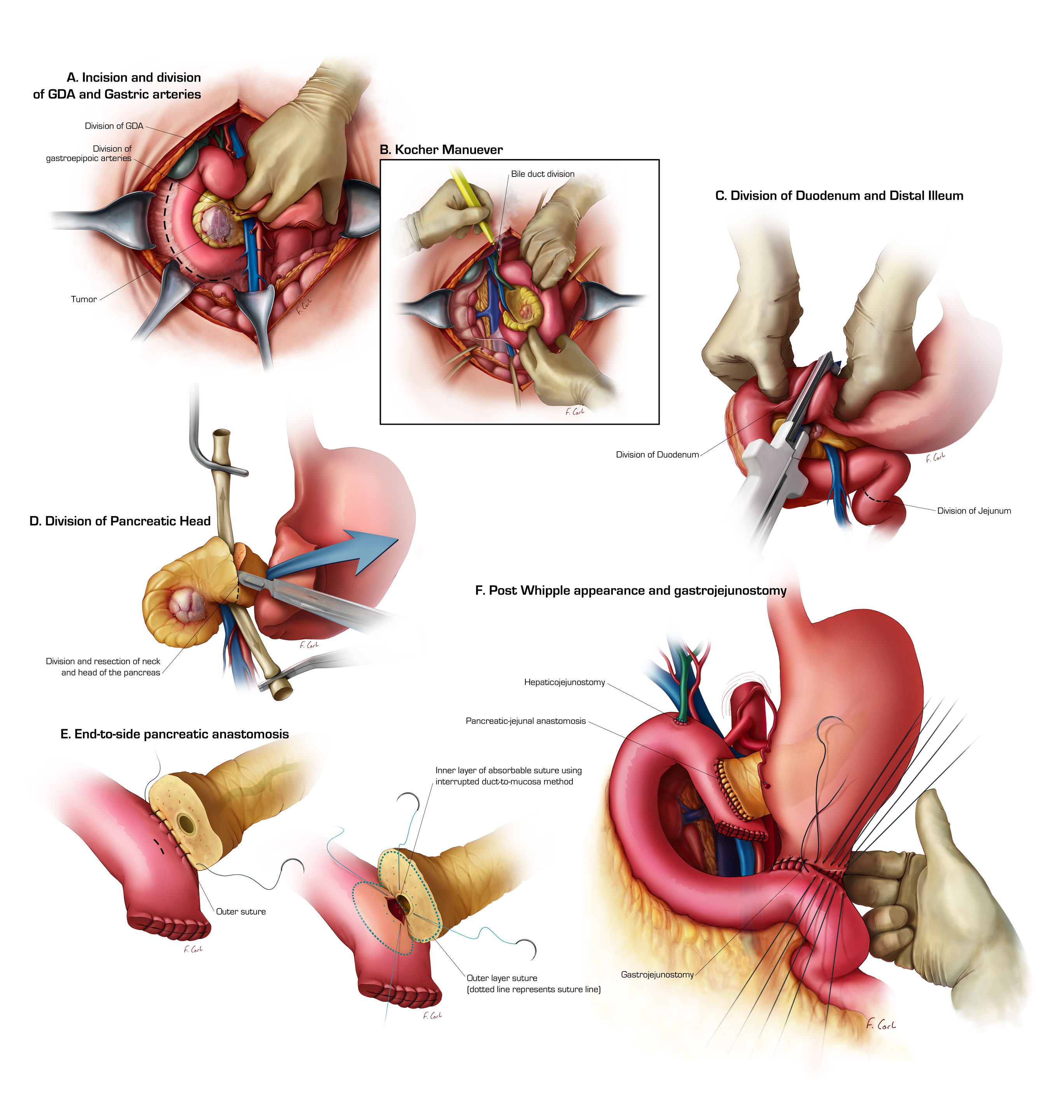 Pancreaticoduodenectomy (Whipple Operation)