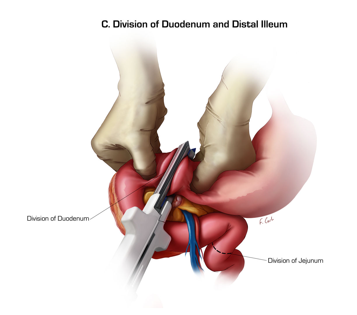 Division of Duodenum and Distal Ileum