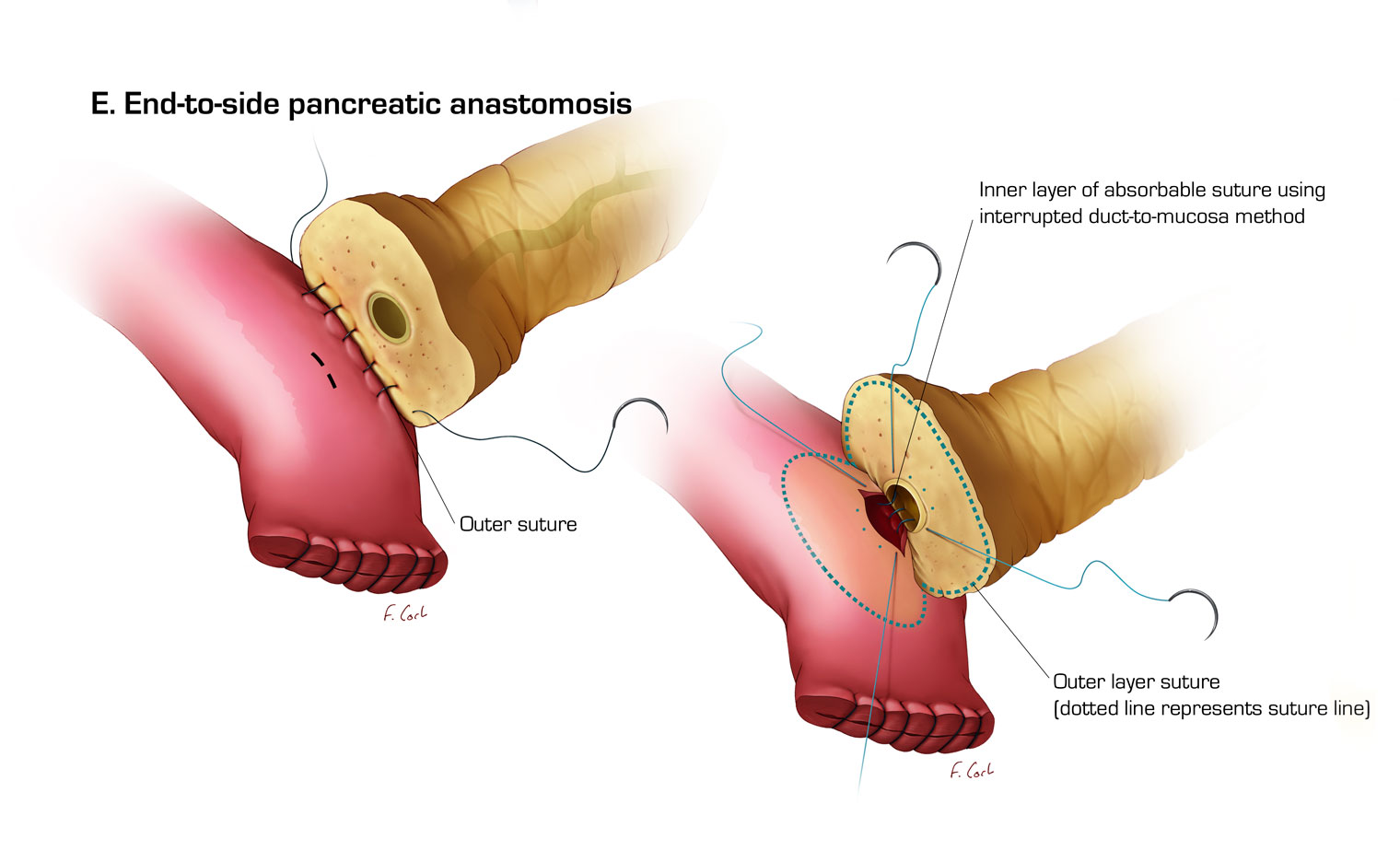 End-to-side pancreatic anastomosis