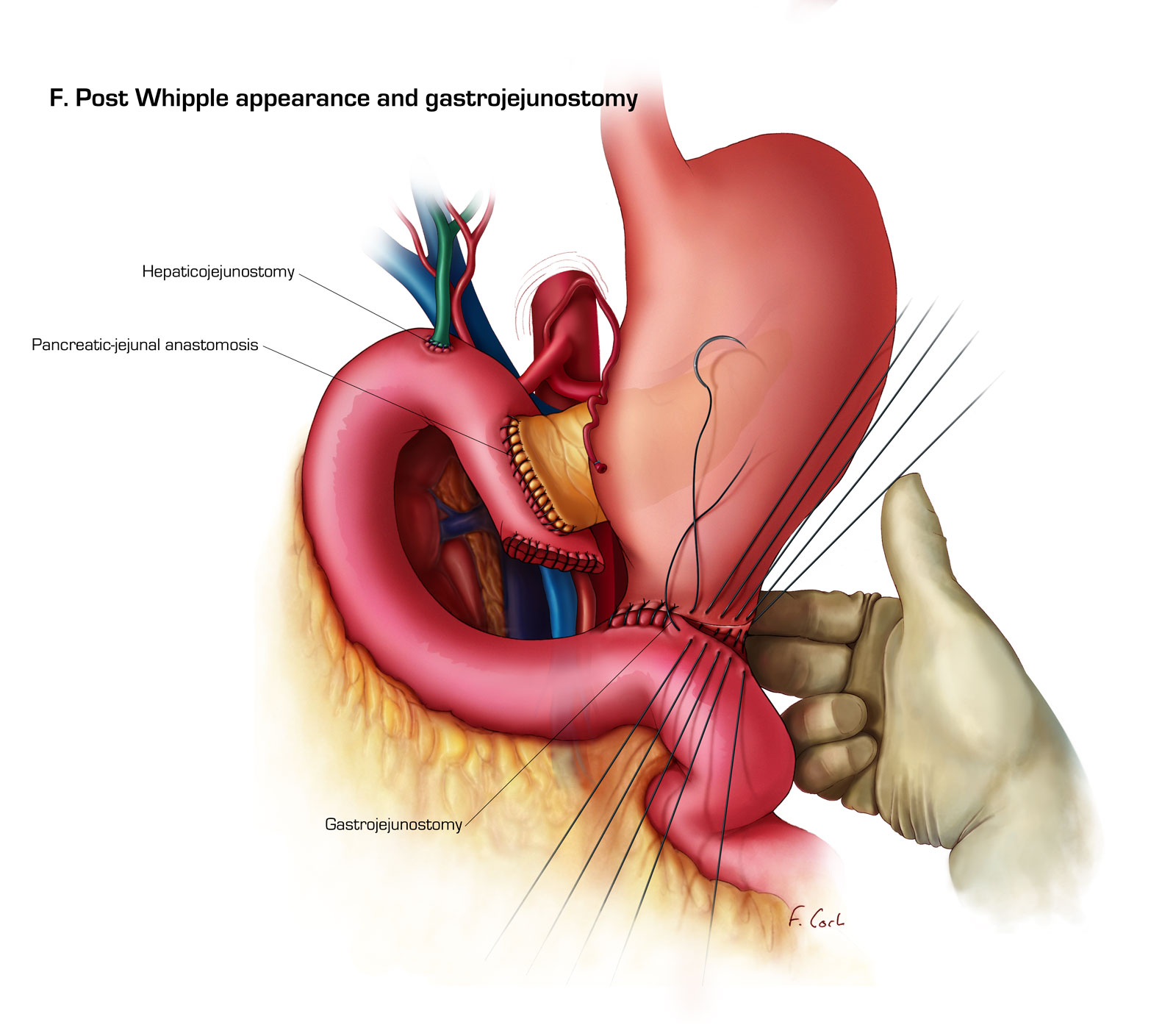 Post Whipple appearance and gastrojejunostomy