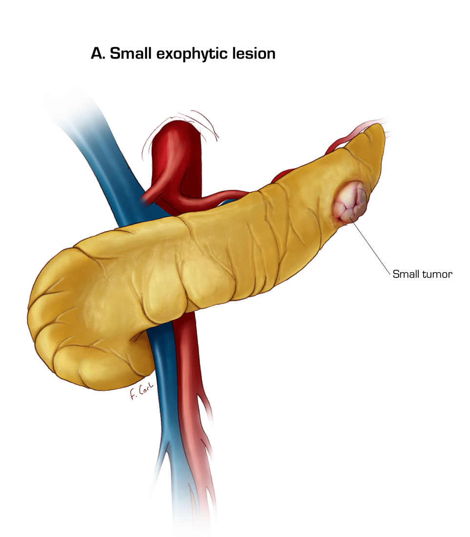 Small Exophytic Tumor