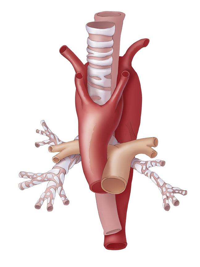 Double Aortic Arch 