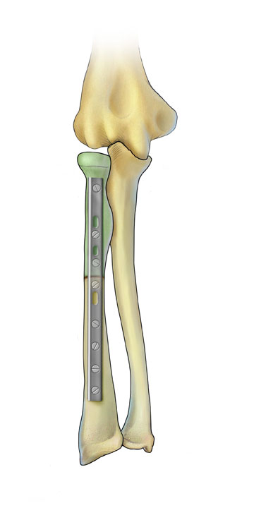 Osteoarticular Allograft of Proximal Radius