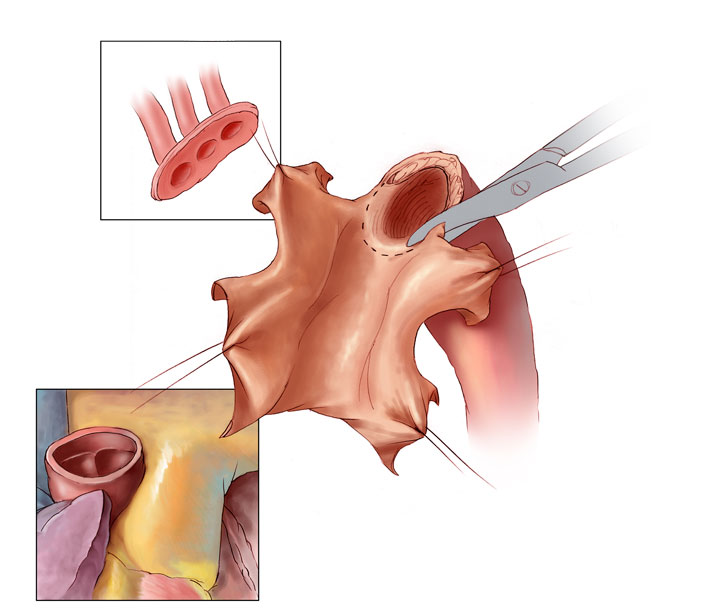Removal of Ascending Aorta