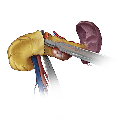 Distal Pancreatectomy: Incision