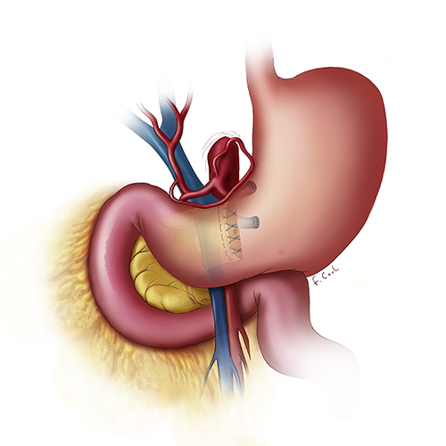 Distal Pancreatectomy: Post Operative View