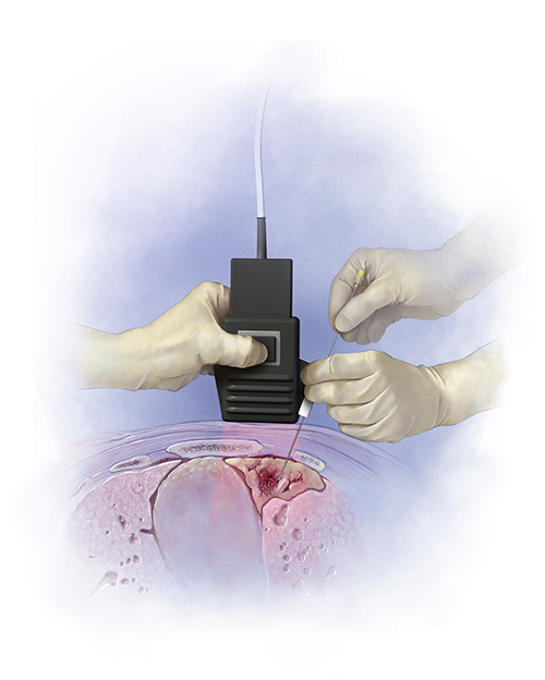 Ultrasound Biopsy