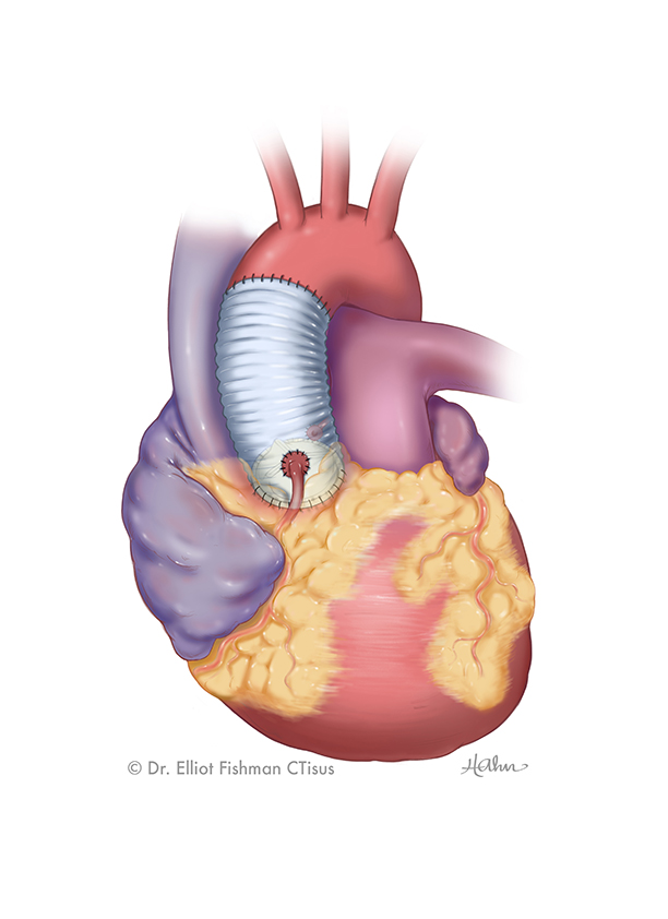 Aortic Root Replacement