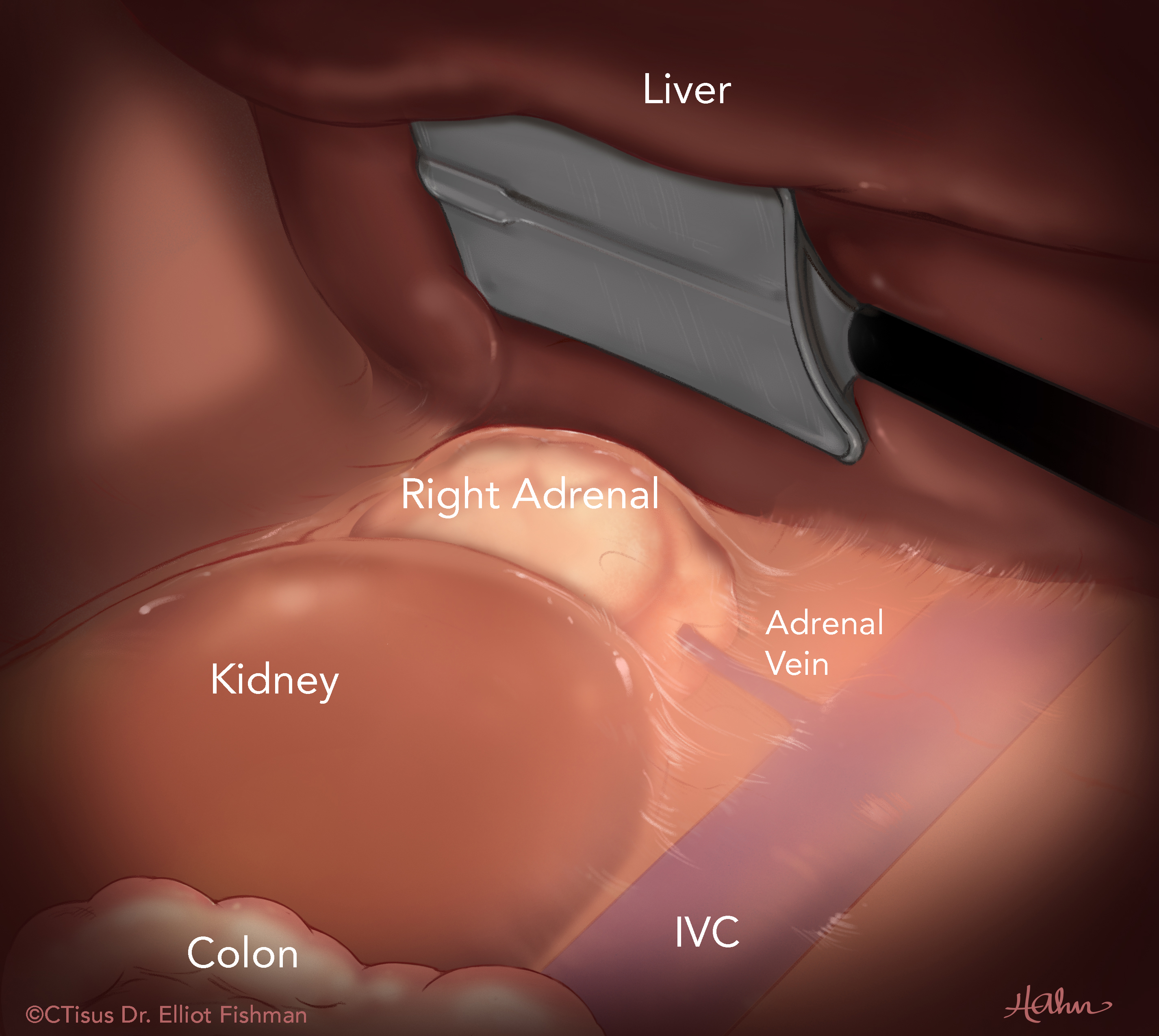 Right Adrenalectomy