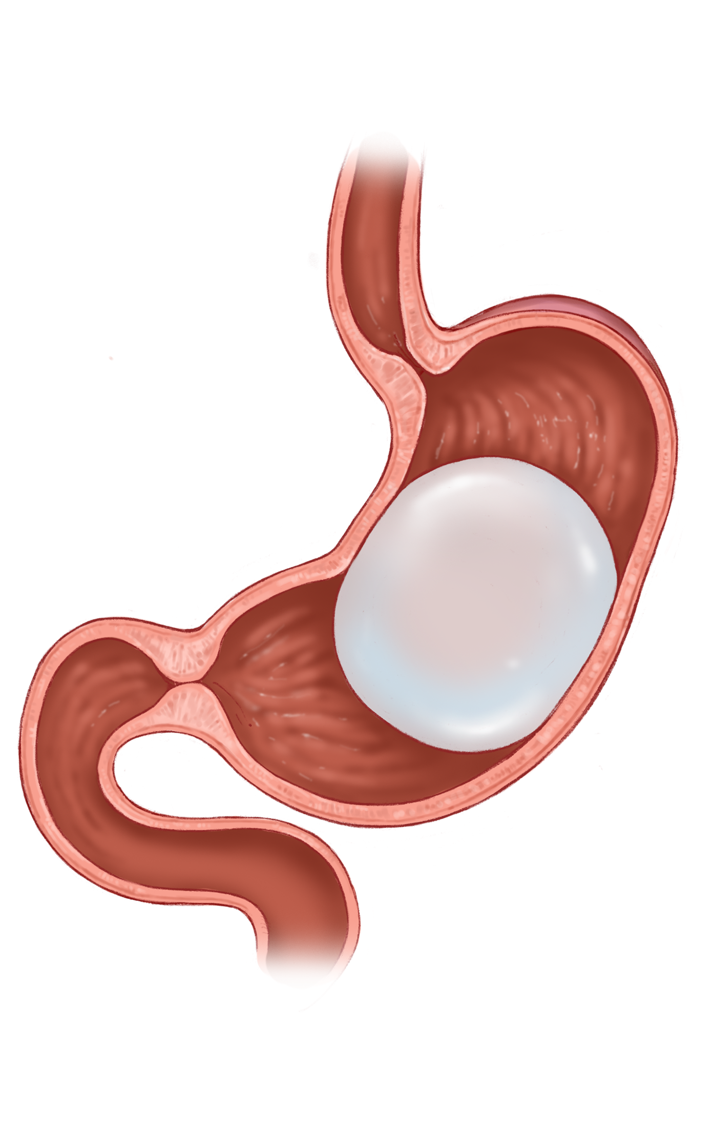 Intragastric Balloon Therapy Normal Post Operative Appearance