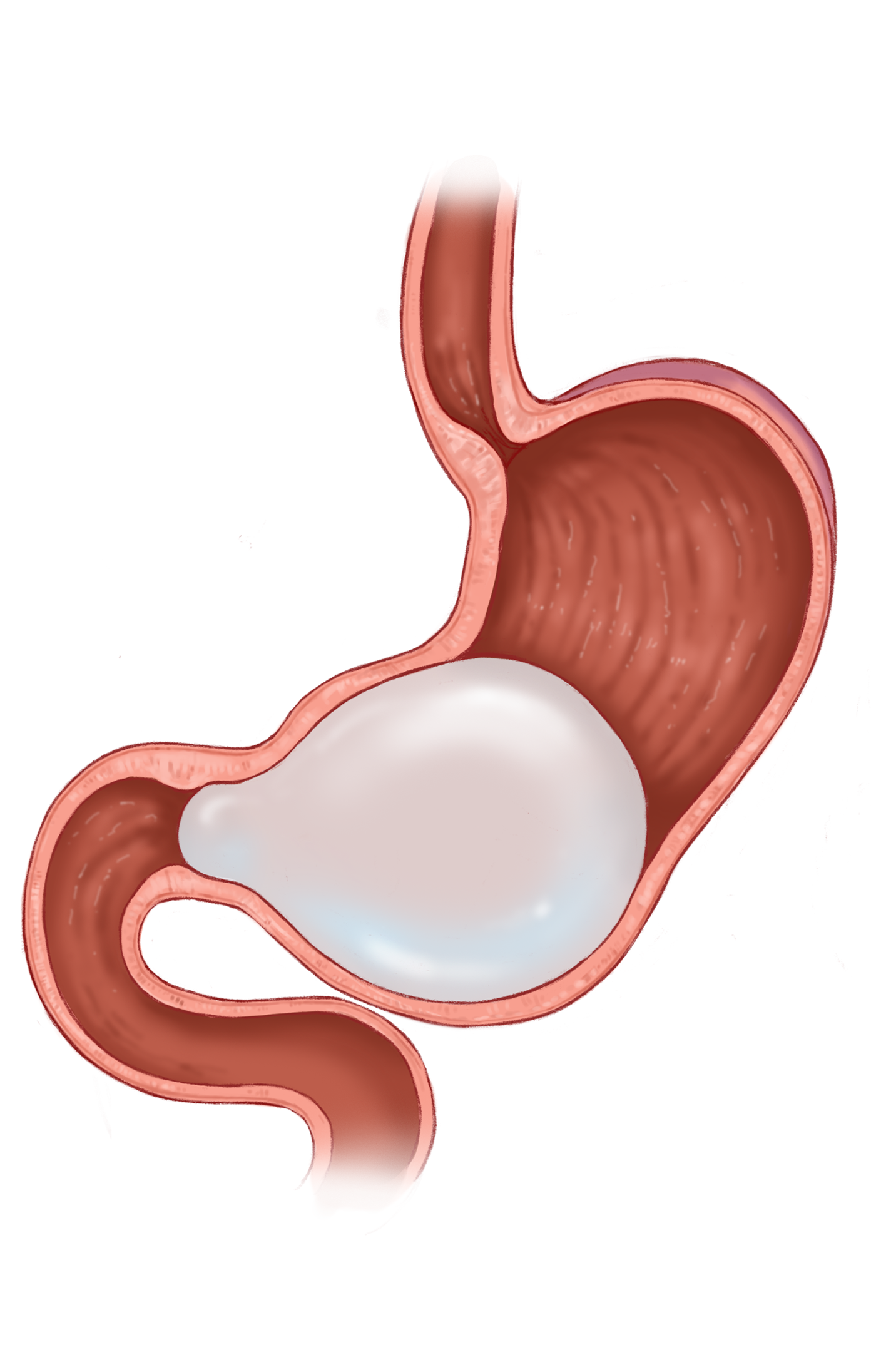 Intragastric Balloon Therapy Gastric Obstruction