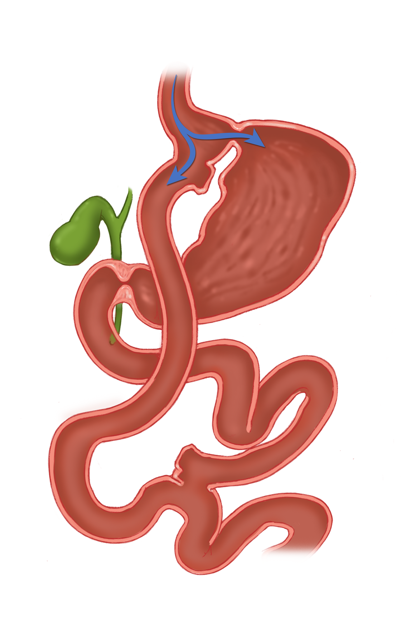 Roux-en-Y Gastric Bypass Gastrogastric Fistula