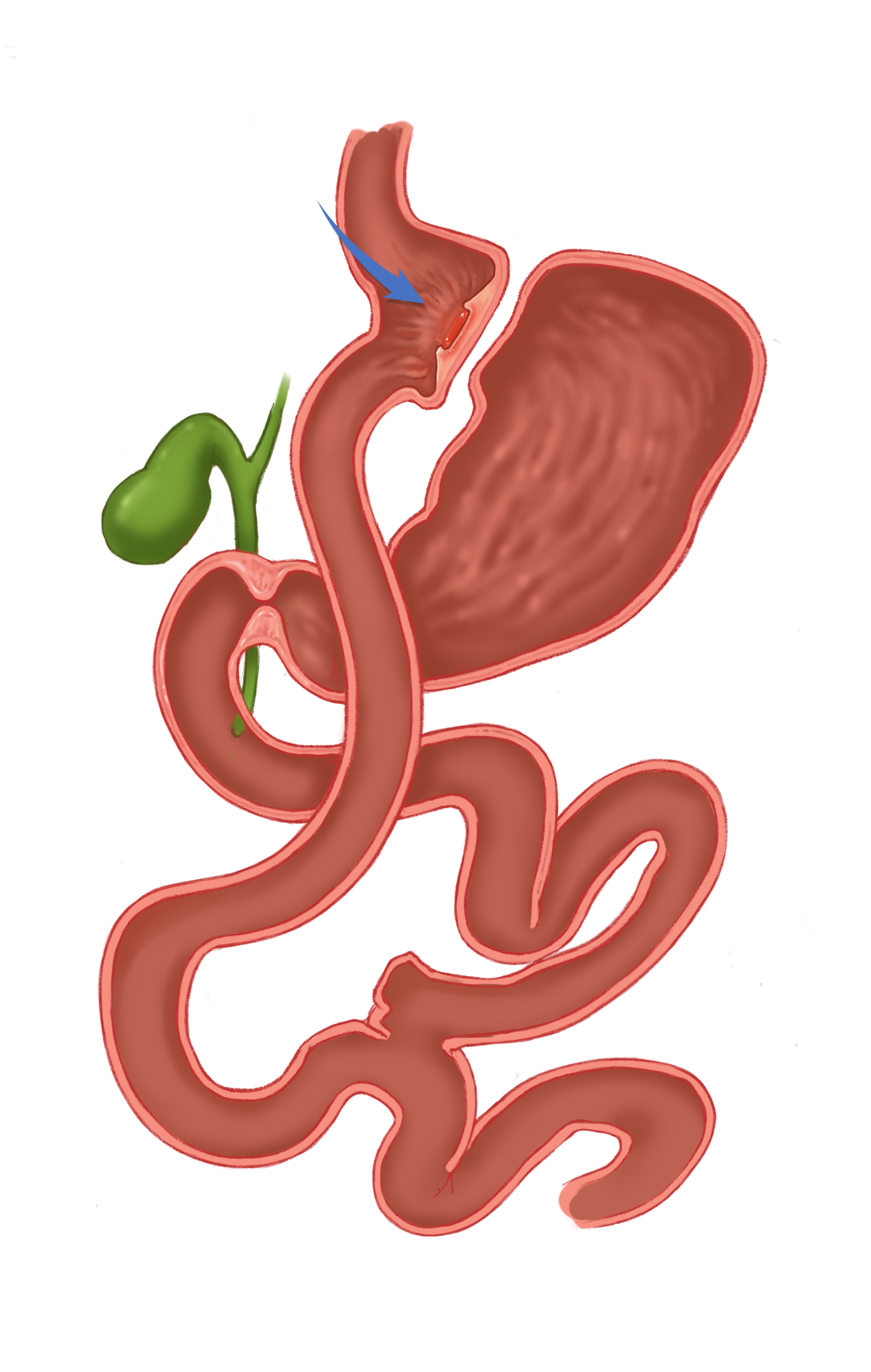 Roux-en-Y Gastric Bypass Marginal Ulcers