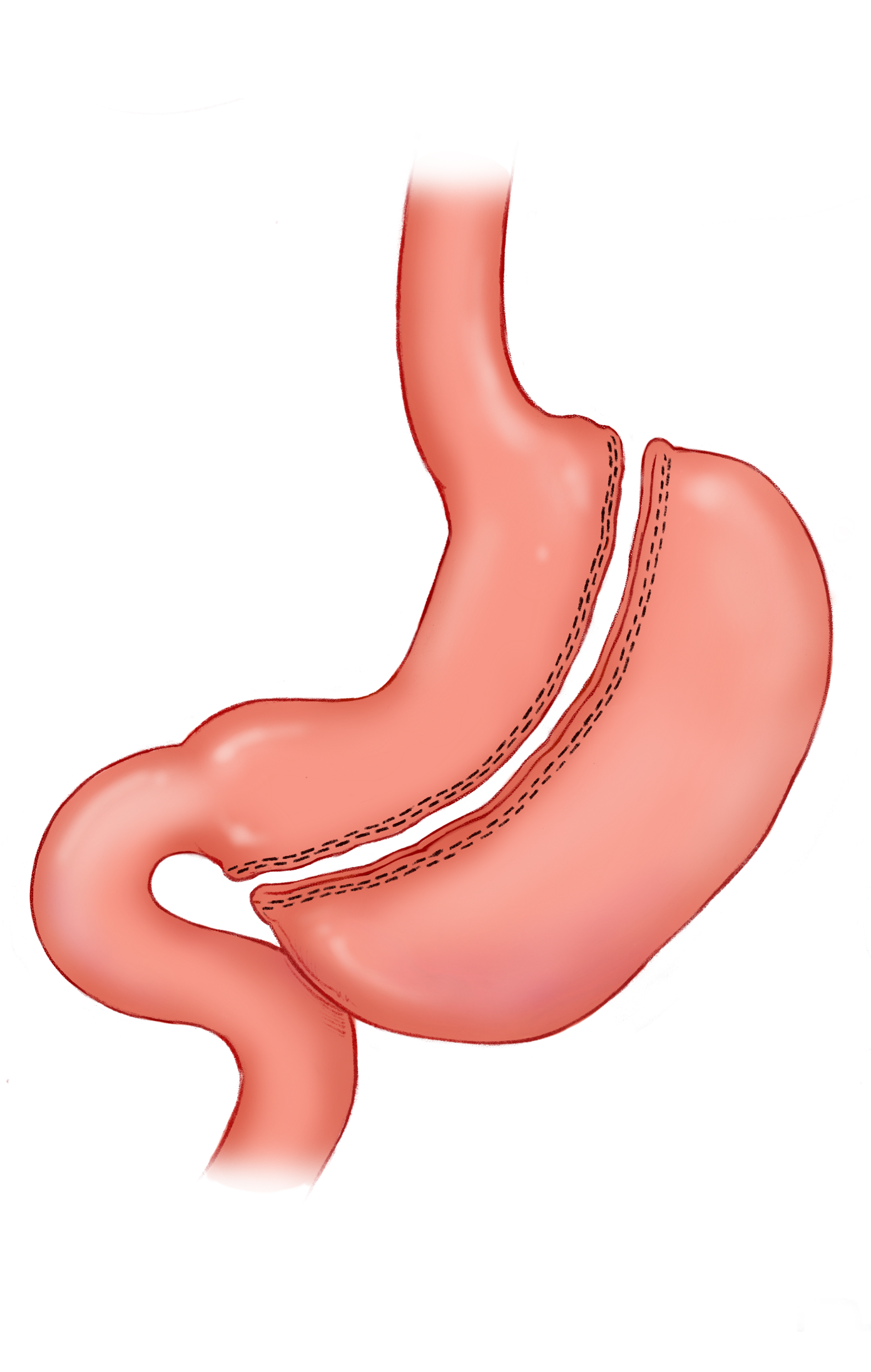Laparoscopic Sleeve Gastrectomy Normal Post Operative Appearance