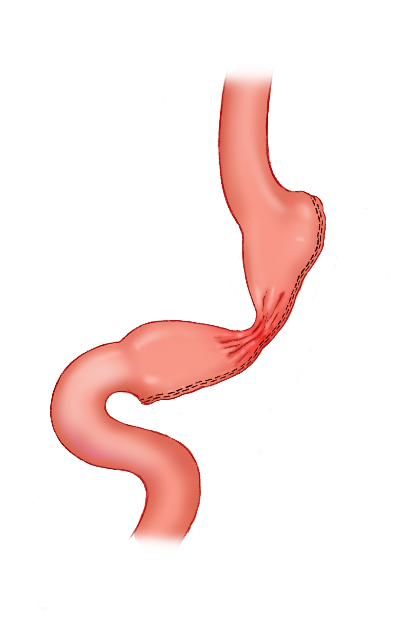 Laparoscopic Sleeve Gastrectomy Stricture