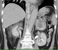 Cystic Primary Adrenal Carcinoma - CTisus CT Scan