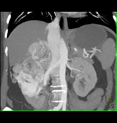 Renal Cell Carcinoma With Adrenal Metastases - CTisus CT Scan
