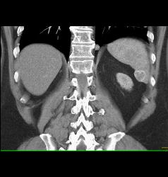 Recurrent Renal Cell Carcinoma Is Metastatic to the Spleen, Adrenal, and Bone - CTisus CT Scan