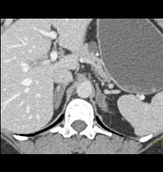 Adrenal Adenomas - CTisus CT Scan