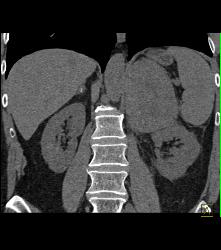 Primary Adrenal Carcinoma - CTisus CT Scan