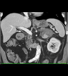 Acute Bleed in Left Adrenal Gland Which Had A Focus of Tumor as Well - CTisus CT Scan