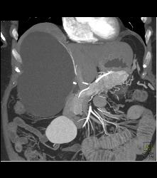 Islet Cell Tumor Tail of Pancreas and the Cystic Adrenal Mass Was An Old Hematoma - CTisus CT Scan