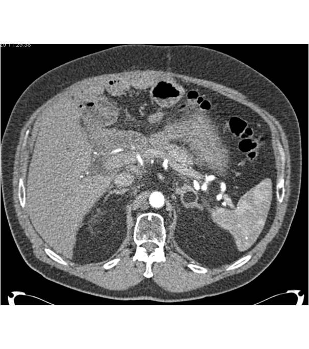 left adrenal myelolipoma - CTisus CT Scan