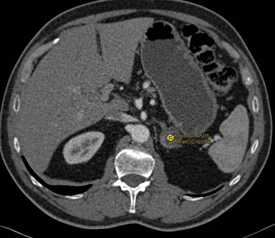 Adrenal Adenoma in a Patient with an Enlarged Prostate - CTisus CT Scan