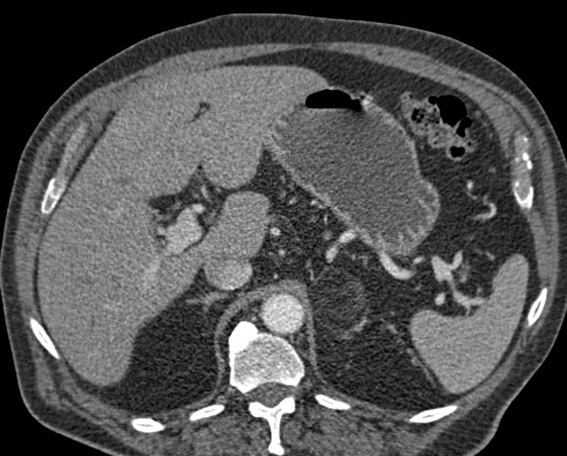 Left Adrenal Myelolipoma - CTisus CT Scan