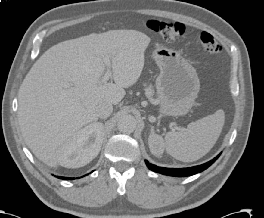 Renal Cell Carcinoma Metastatic to the Left Adrenal Gland - CTisus CT Scan