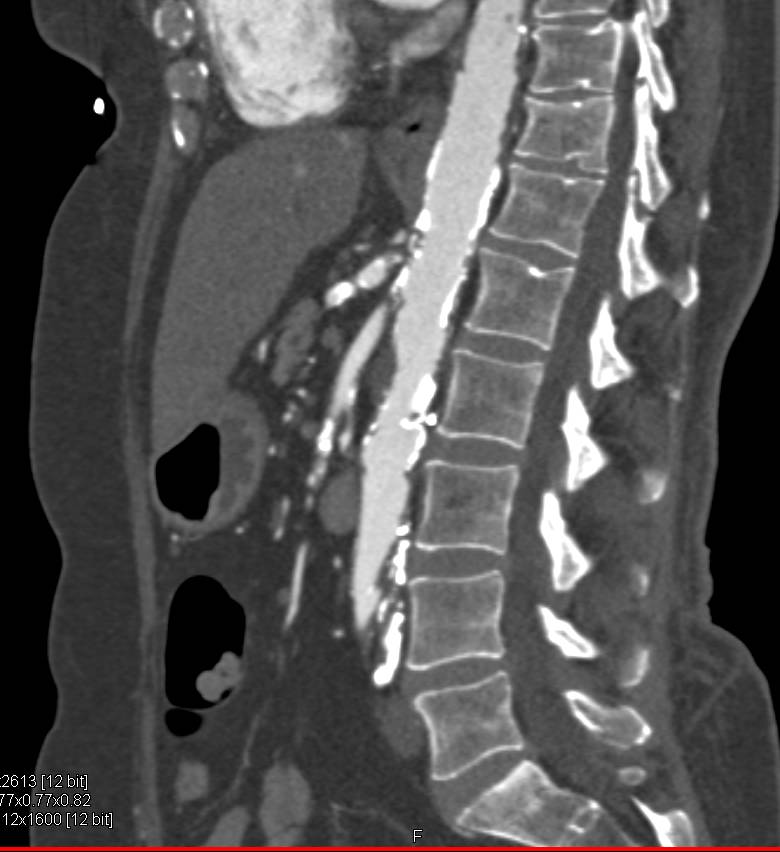 Extensive Vascular Disease Involves the Mesenteric Circulation as well as the Iliac Arteries and the Superficial Femoral Arteries (SFAs) and the Runoff Vessels. Fem-Fem Bypass Also Seen. - CTisus CT Scan