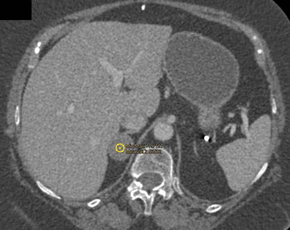 Adrenal Adenoma that does not Washout 50% - CTisus CT Scan