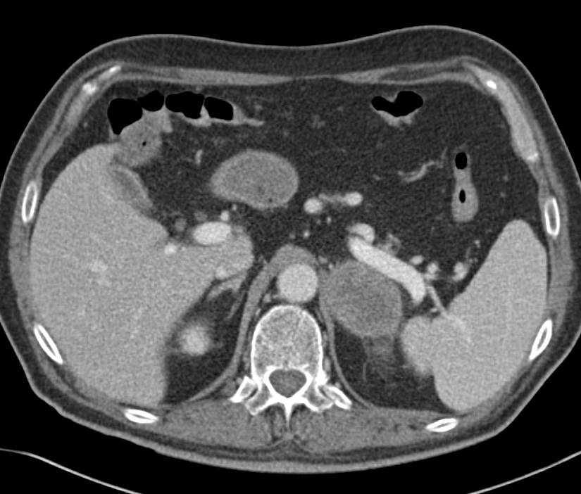 Melanoma Metastatic to the Left Adrenal Gland - CTisus CT Scan