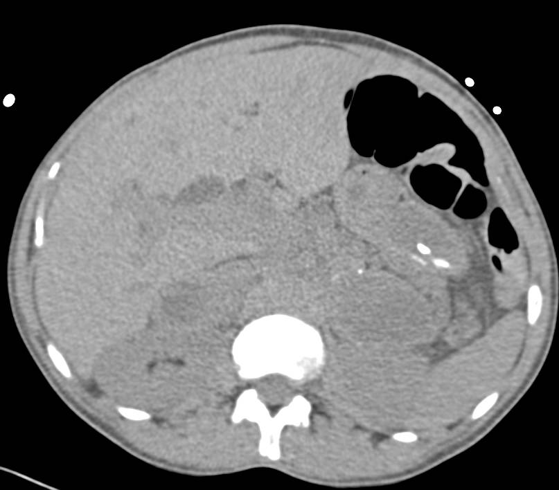 Bilateral Adrenal Metastases from Melanoma - CTisus CT Scan
