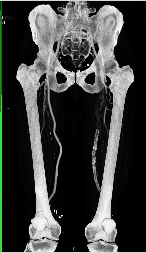 needCTA Runoff with Dual Energy and Single Energy with Occluded Right Superficial Femoral Artery (SFA)-Popliteal Graft and Bilateral Peripheral Vascular Disease (PVD). DE vs SE with Bone Removal - CTisus CT Scan