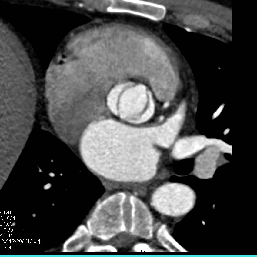 Bicuspid Aortic Valve - CTisus CT Scan