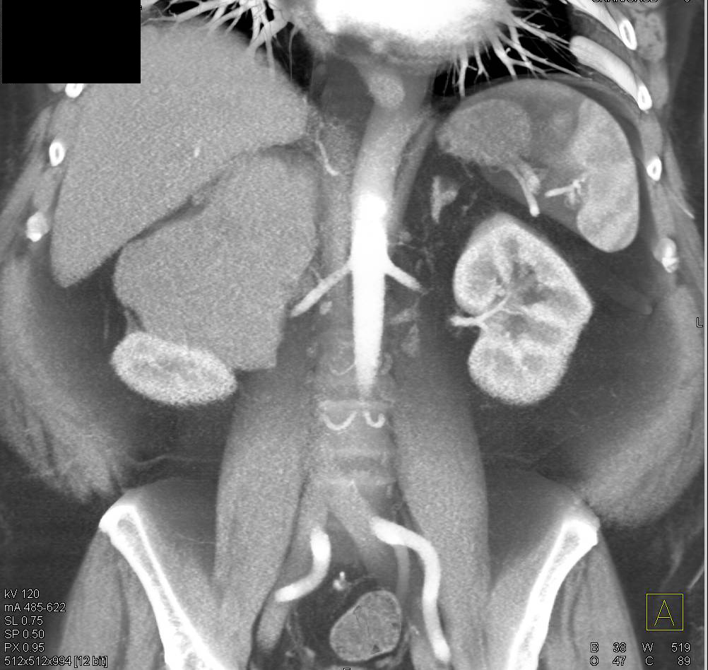 Primary Adrenal Lymphoma - CTisus CT Scan
