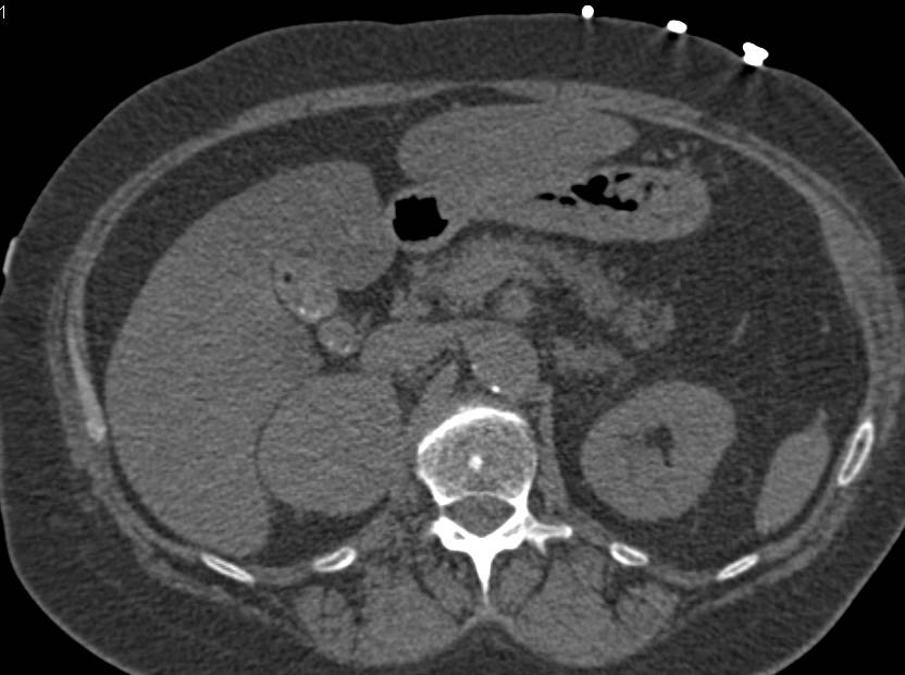 Right Adrenal Pheochromocytoma - CTisus CT Scan