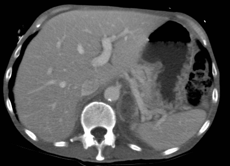 Old Left Adrenal Hematoma - CTisus CT Scan